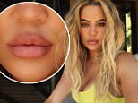 Khloe Kardashian showcases plump lips on Instagram