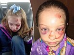 Girl concussed in 'attack from bully at elementary school'