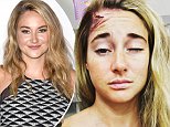 Shailene Woodley shares snaps of makeup injury for Adrift