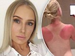 Lauren Curtis reveals shocking sunburn on Instagram