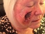 Sunbed addict left with hole in face from skin cancer