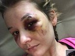 Victim raped by boyfriend shares pictures of her injuries