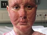 Kim Debling shares photos of incurable cancer's disfiguring effects