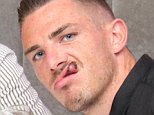 Newcastle Utd star Ciaran Clark sports ugly facial scar after attack in Magaluf nightclub